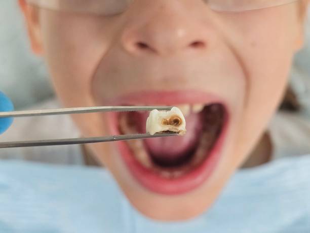 Best Emergency Tooth Extraction in Broadway, NC